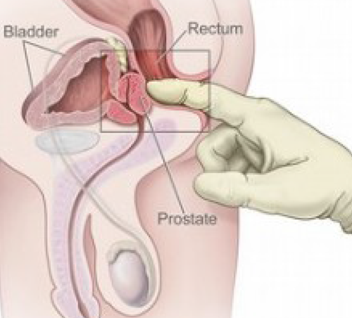 Do Prostate Massages Help Prevent cancer