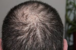 how to prevent hair loss, grey hair natural remedies, natural remedies for hair loss ,