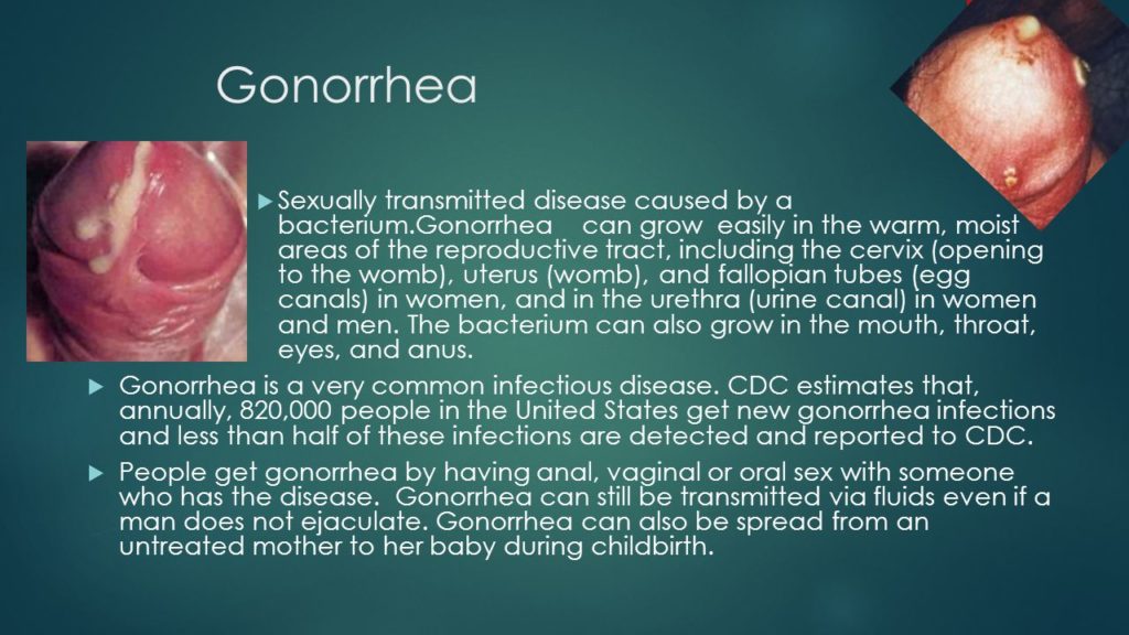 what does gonorrhea look like