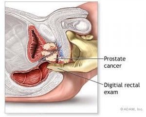 prostate massage , prostate milking