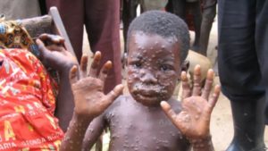 monkeypox in nigeria