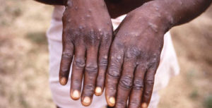 monkey pox in Nigeria