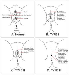 female circumcision before and after