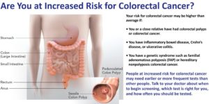 How Long Does Colon Cancer Take To Develop Develop