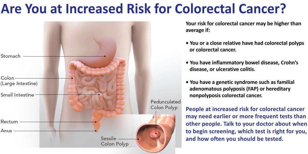 How Long Does Colon Cancer Take To Develop Develop