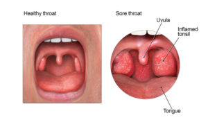 How To Cure A Sore [Strep] Throat Fast