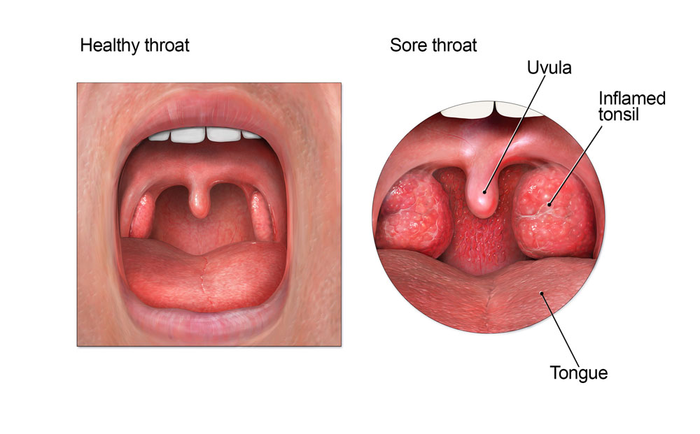 How To Cure A Sore [Strep] Throat Fast