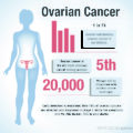 How to Detect Ovarian Cancer