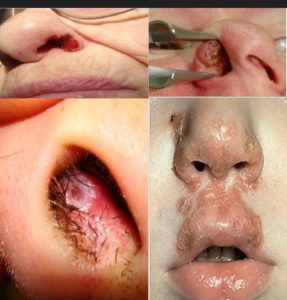 Sores in Nose