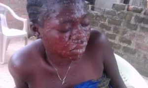 monkey pox in Nigeria