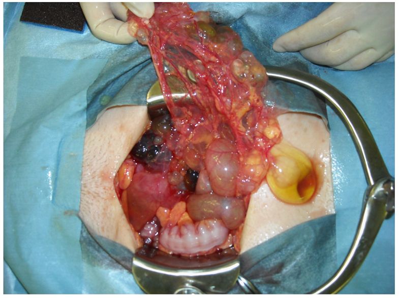 Multicystic Peritoneal Mesothelioma