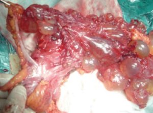 Multicystic Peritoneal Mesothelioma