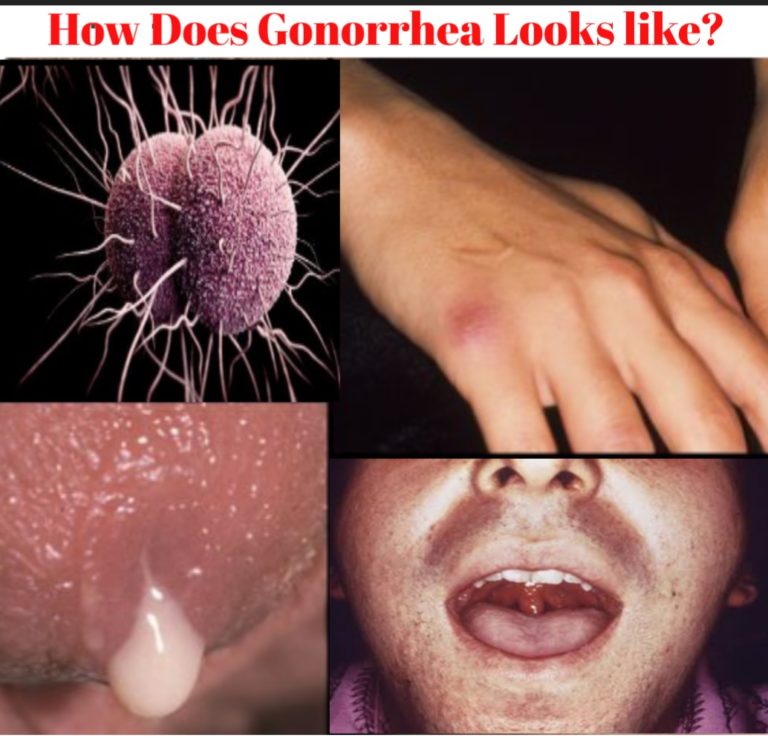 All 97+ Images show me pictures of gonorrhea Updated
