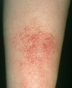 poison oak arm rash