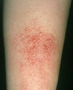 poison oak arm rash