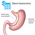 Gastric Sleeve Cost