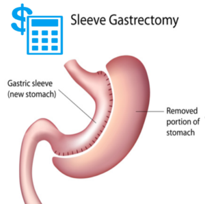 Gastric Sleeve Cost 