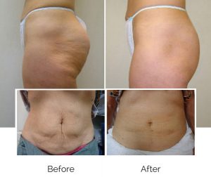 before and after testosterone pellets for women