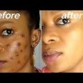 How To Naturally Remove Dark Spots On Face Overnight