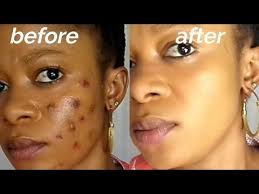 How To Naturally Remove Dark Spots On Face Overnight