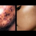 pimples and dark spots removal in Nigeria