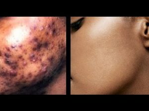 pimples and dark spots removal in Nigeria