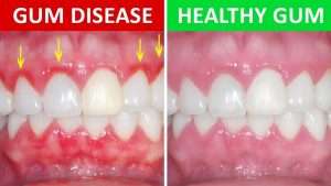 Gum Disease and kissing
