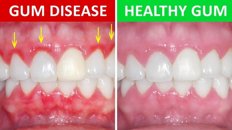 Can You Get Periodontal Disease From Kissing