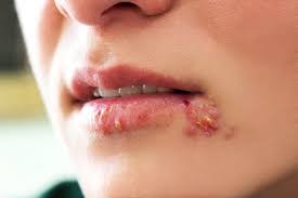 How Long Does a Herpes outbreak last