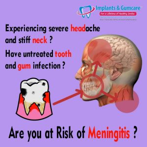 Meningitis and kissing