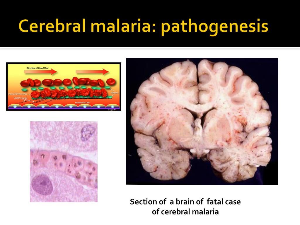 case study cerebral malaria
