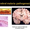 WHO Definition of Cerebral malaria