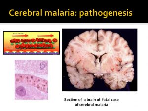 WHO Definition of Cerebral malaria