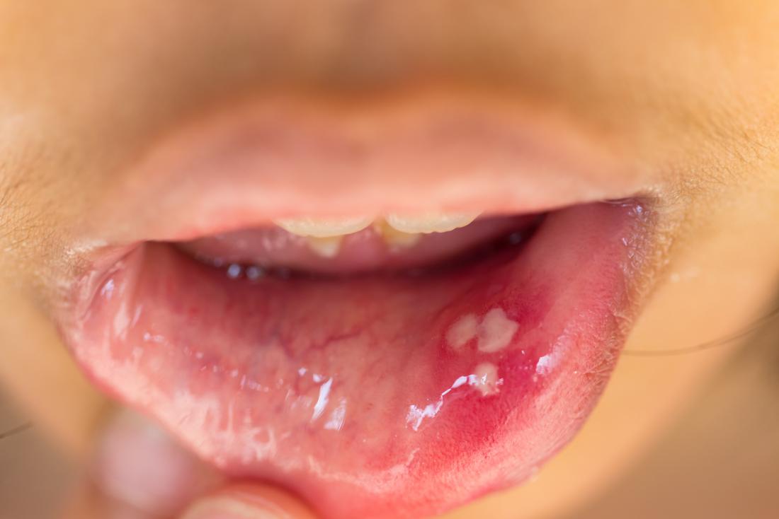 hpv in the mouth and kissing