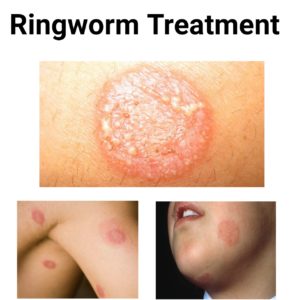 Best Drugs For Ringworm Treatment