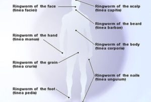 types of ringworm