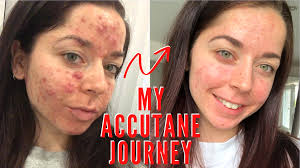 Accutane Before and After