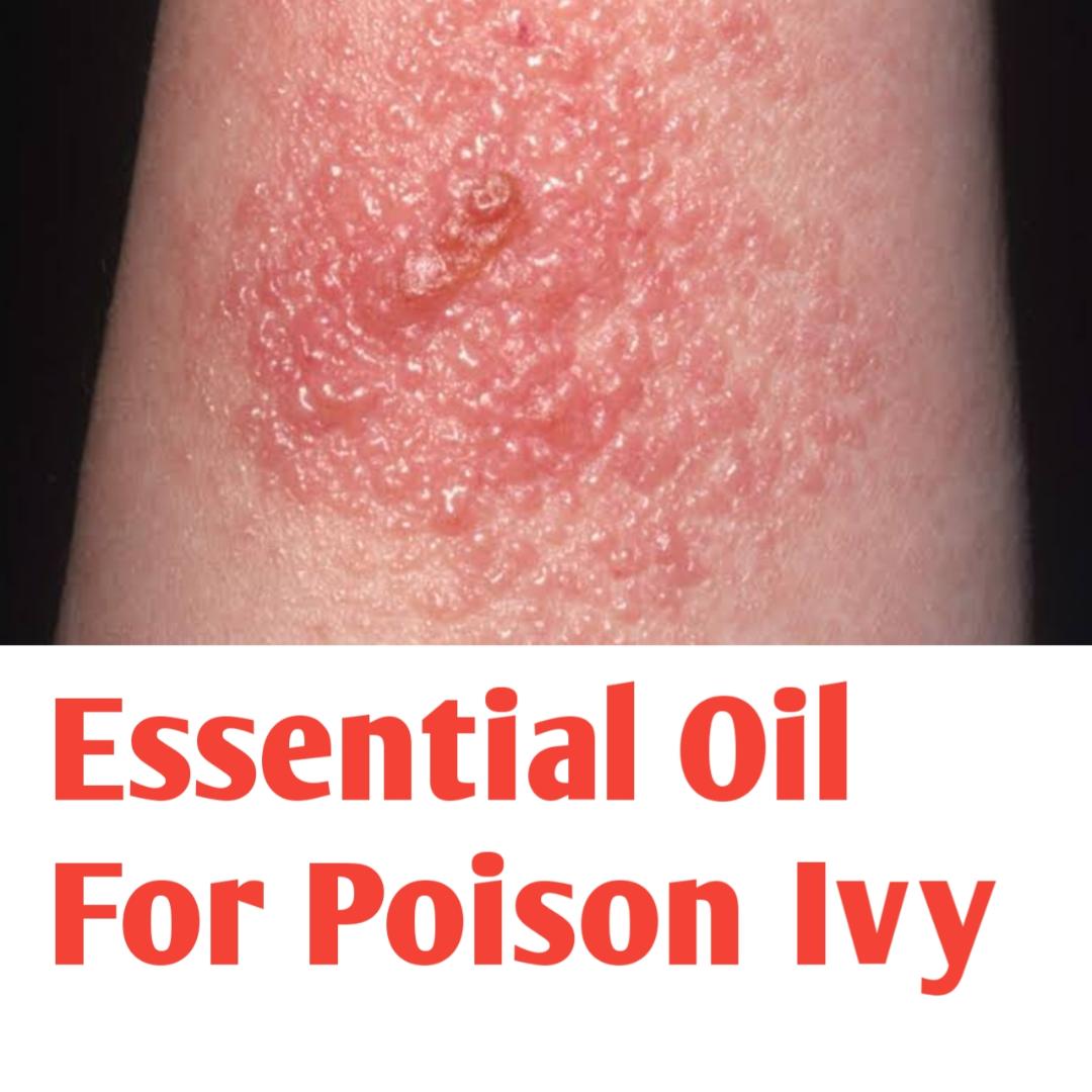 Essential Oil For Poison Ivy