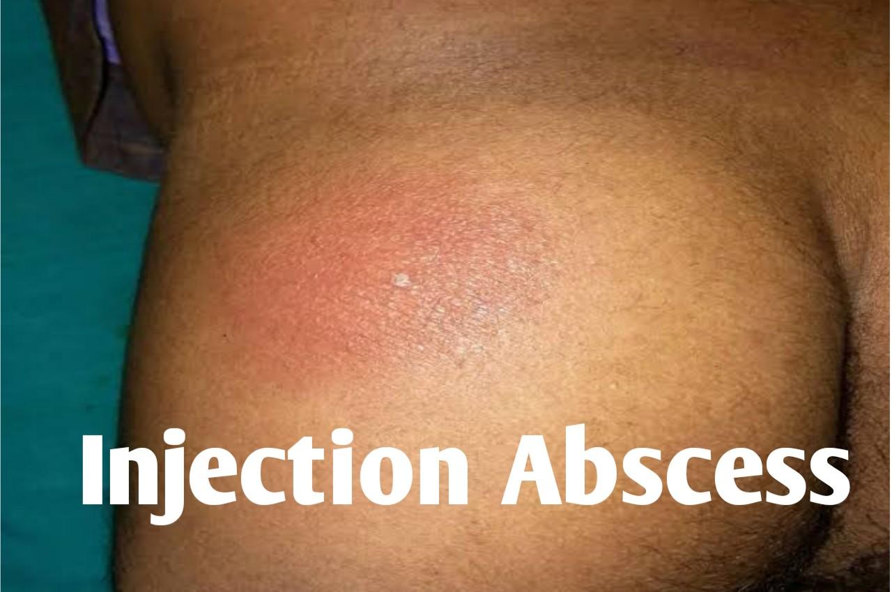 Abscess From Testosterone Injection