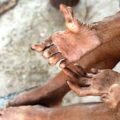 What is leprosy?