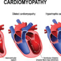 Alcoholic Cardiomyopathy