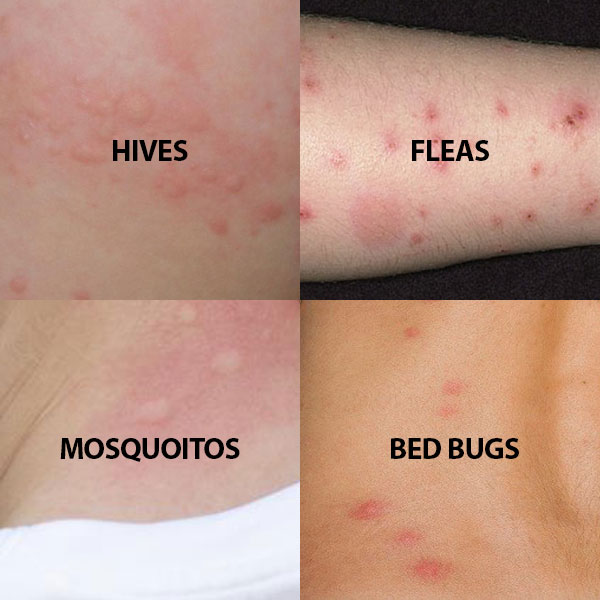 Bed bug bites vs. hives