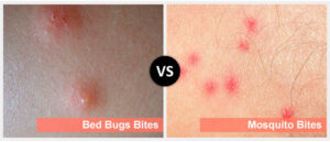 Bed bug bites vs. mosquito bites