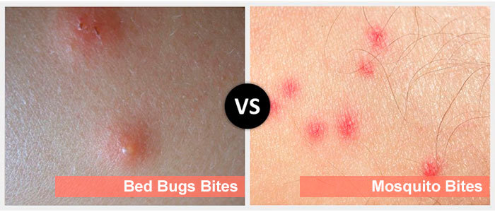 Mosquito and Bedbugs Bites | Public Health