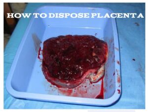 How To Dispose Placenta After Birth
