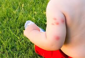 Bed bug bites on a baby