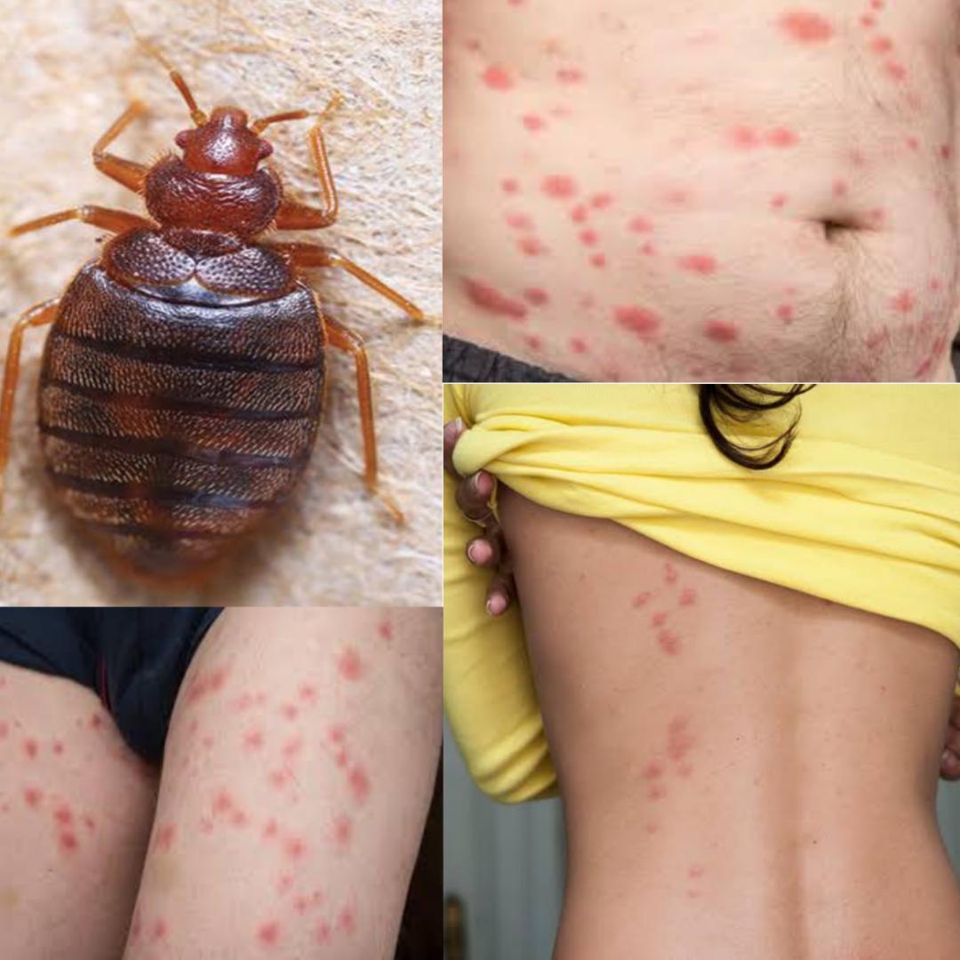 bed bug bites picture
