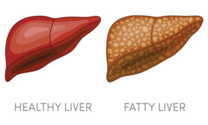 Alcoholic Fatty Liver