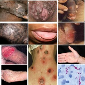 syphilis rash