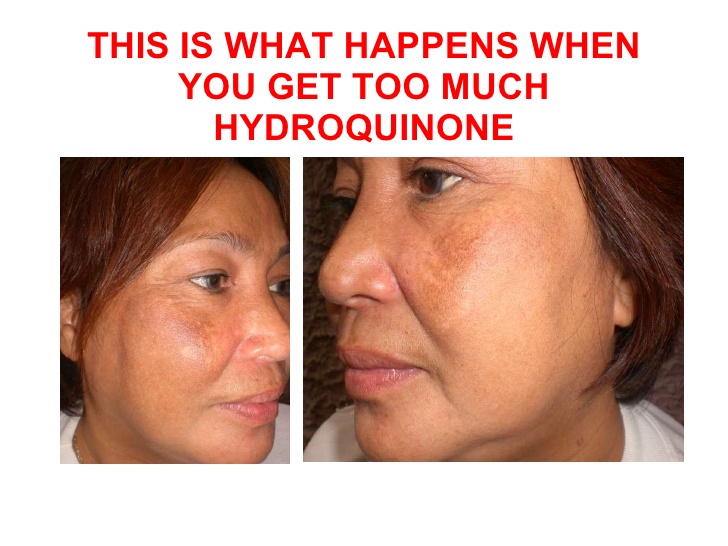 Does K Brothers Cream Contains Hydroquinone